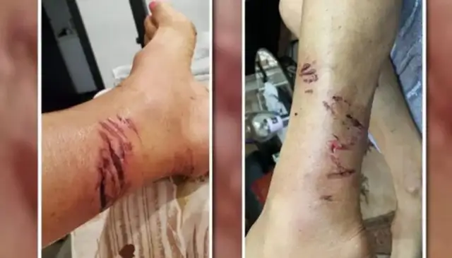 Shit! Canadian girls walk their dogs home and get bit by a bunch of raccoons