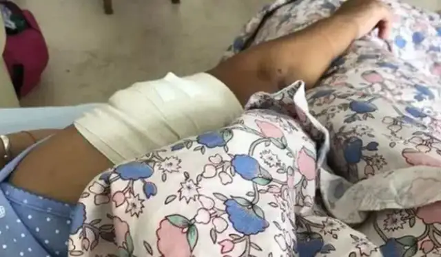 It's not the first time a woman has been bitten by a dog for five years
