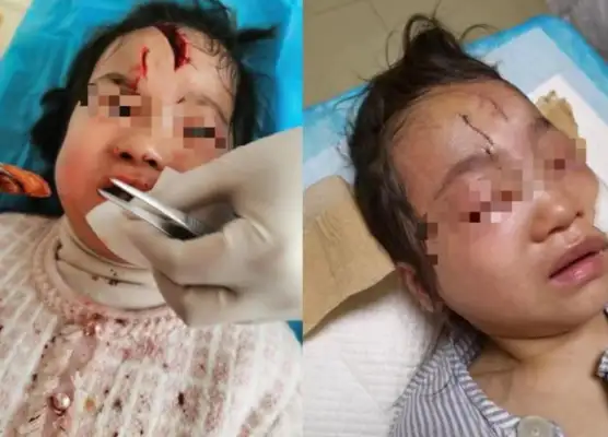 Jiangsu-shin moved, a public official had no dog ropes, and a 5-year-old girl was bitten by a dog and disfigured