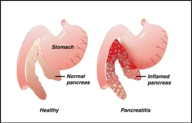 Secrets for acute pancreas: combination of pain, nutrition and liquid therapy